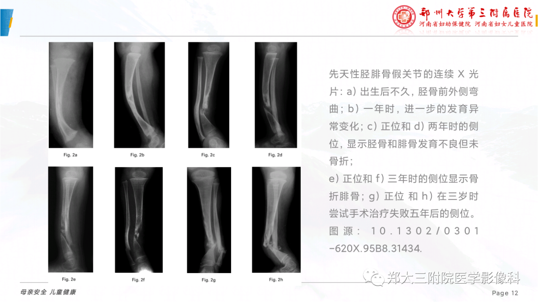 影像PPT - 【PPT】儿童先天性胫骨假关节-12