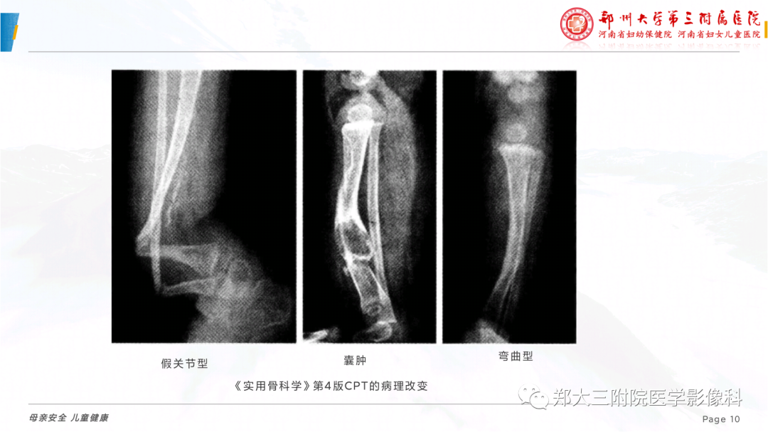 影像PPT - 【PPT】儿童先天性胫骨假关节-10