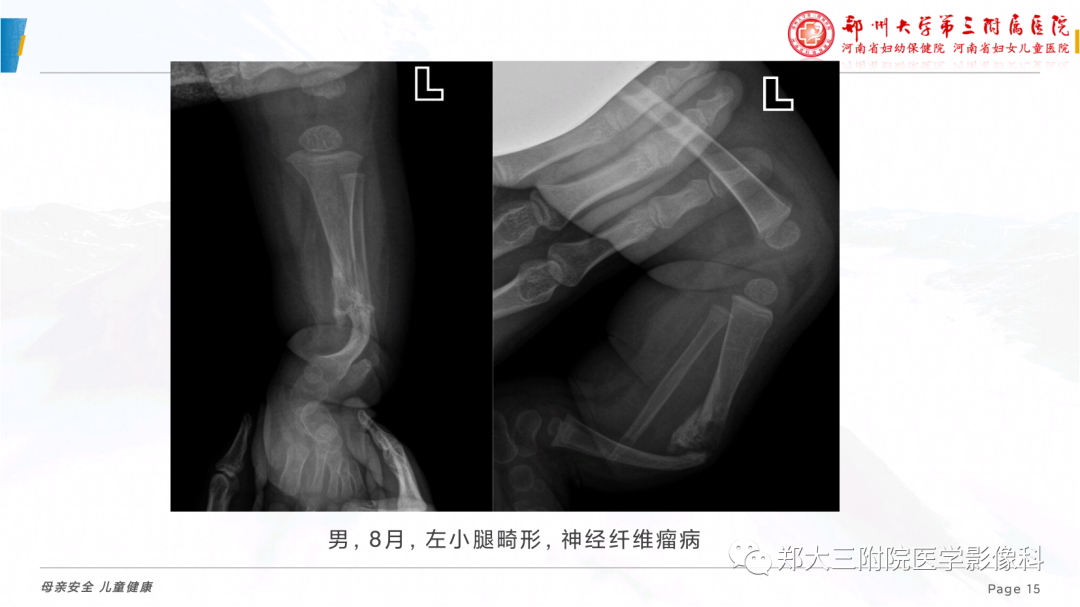 影像PPT - 【PPT】儿童先天性胫骨假关节-15