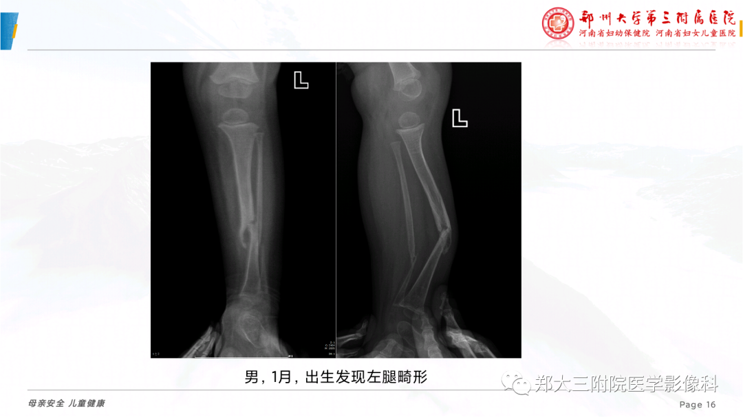 影像PPT - 【PPT】儿童先天性胫骨假关节-16