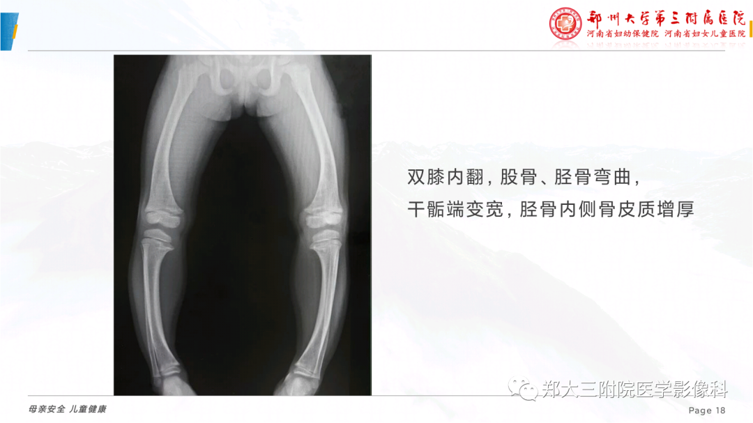 影像PPT - 【PPT】儿童先天性胫骨假关节-18