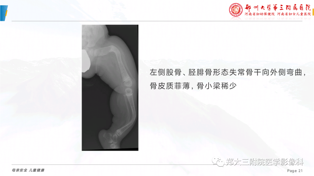 影像PPT - 【PPT】儿童先天性胫骨假关节-21