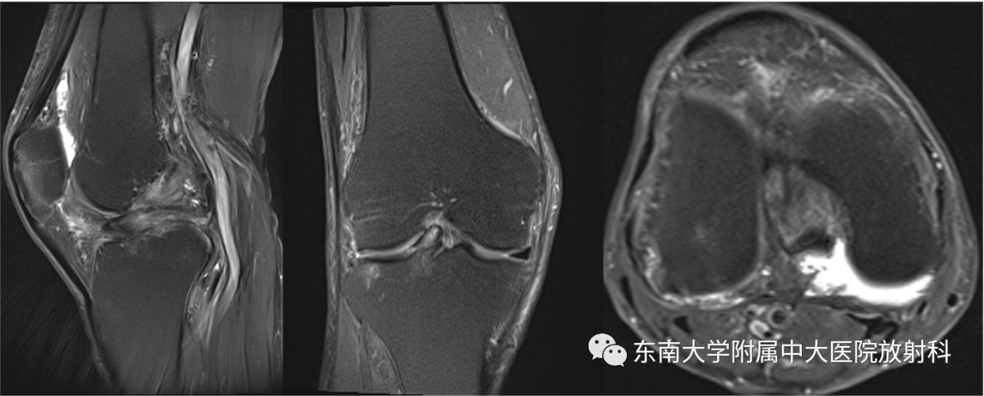 影像PPT - 【PPT】半月板撕裂-1