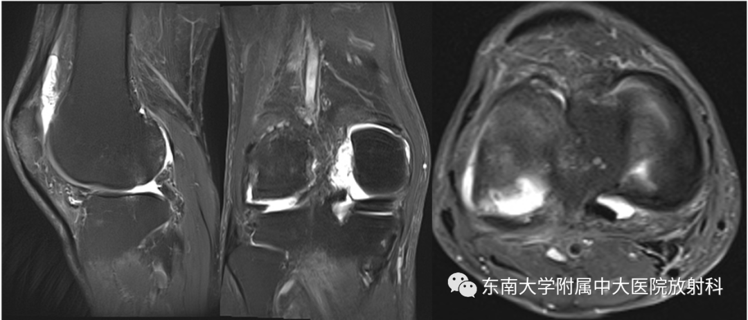 影像PPT - 【PPT】半月板撕裂-2