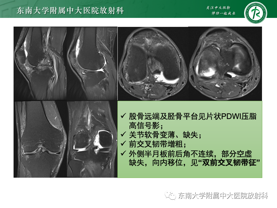 影像PPT - 【PPT】半月板撕裂-4
