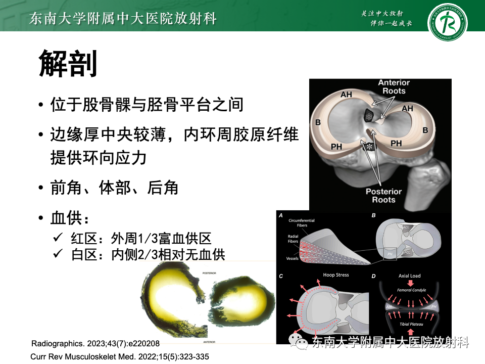 影像PPT - 【PPT】半月板撕裂-7