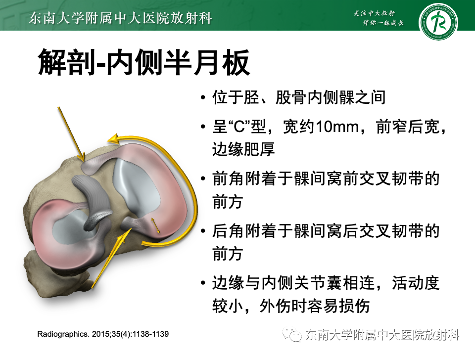 影像PPT - 【PPT】半月板撕裂-8