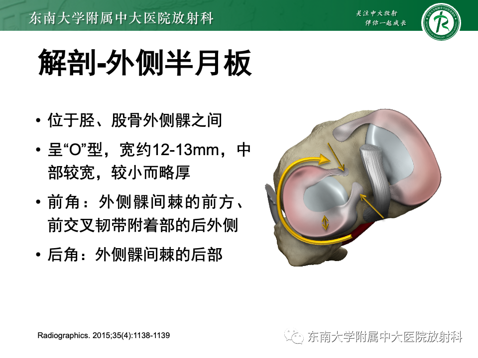 影像PPT - 【PPT】半月板撕裂-9