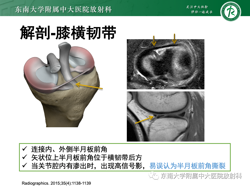 影像PPT - 【PPT】半月板撕裂-11