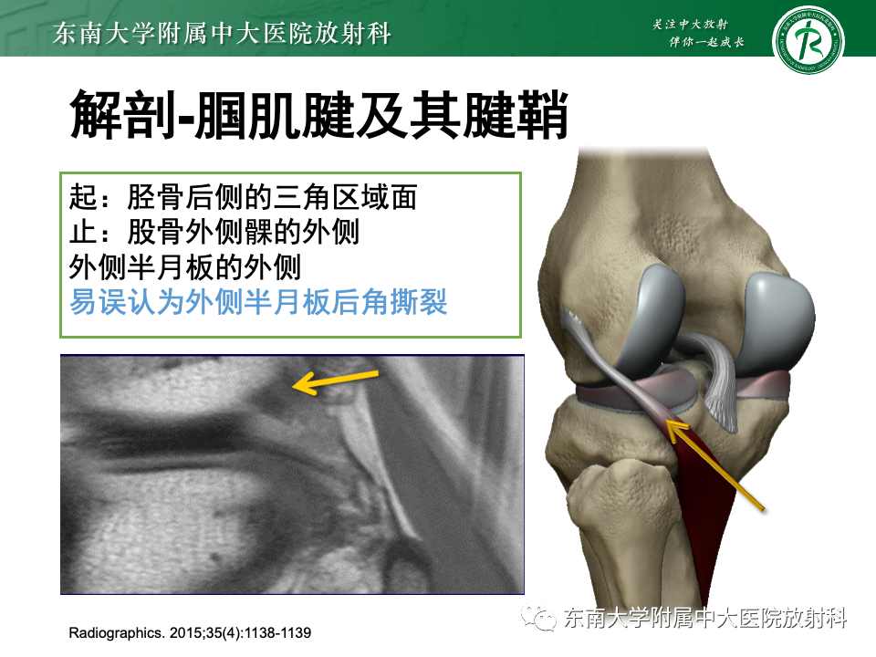 影像PPT - 【PPT】半月板撕裂-13