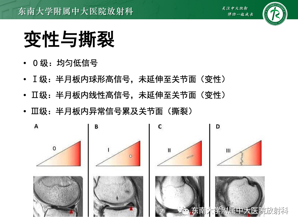 影像PPT - 【PPT】半月板撕裂-14