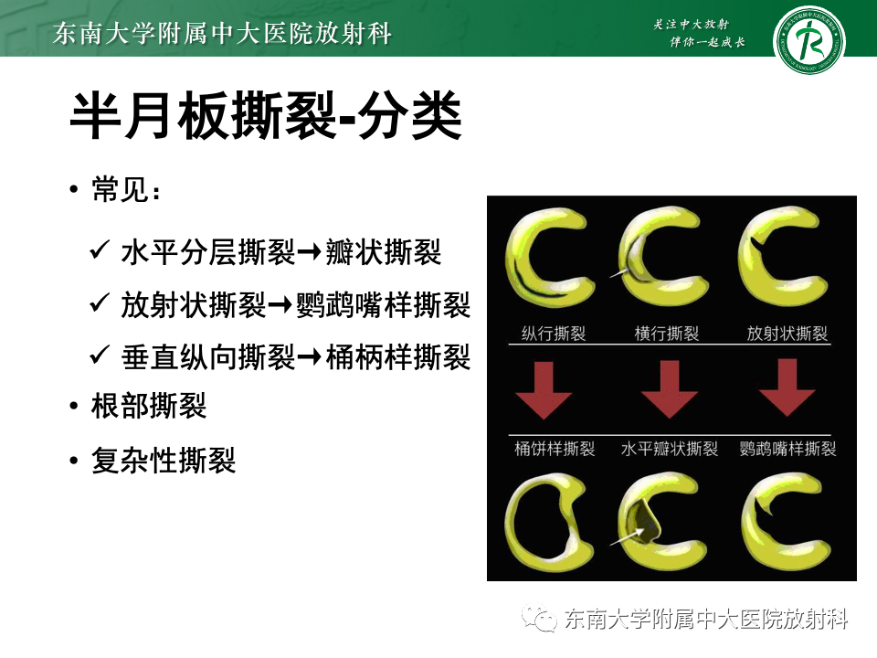 影像PPT - 【PPT】半月板撕裂-16