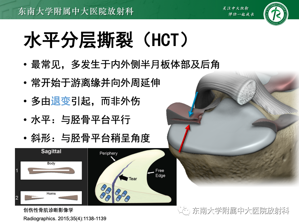 影像PPT - 【PPT】半月板撕裂-17