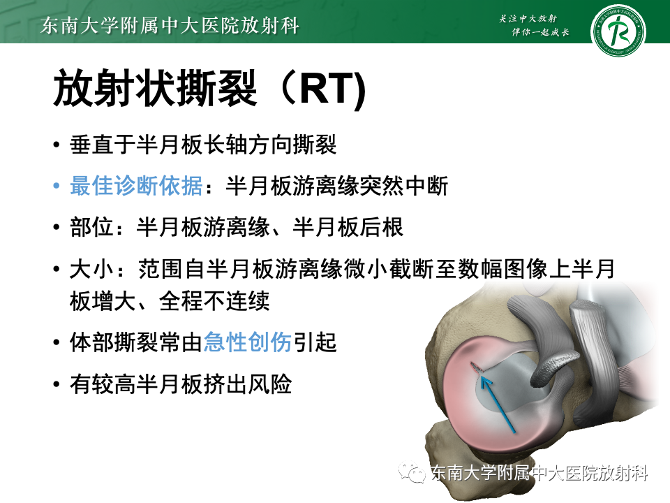 影像PPT - 【PPT】半月板撕裂-19