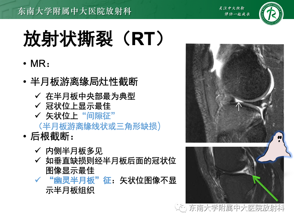 影像PPT - 【PPT】半月板撕裂-20