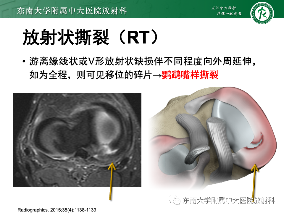 影像PPT - 【PPT】半月板撕裂-21