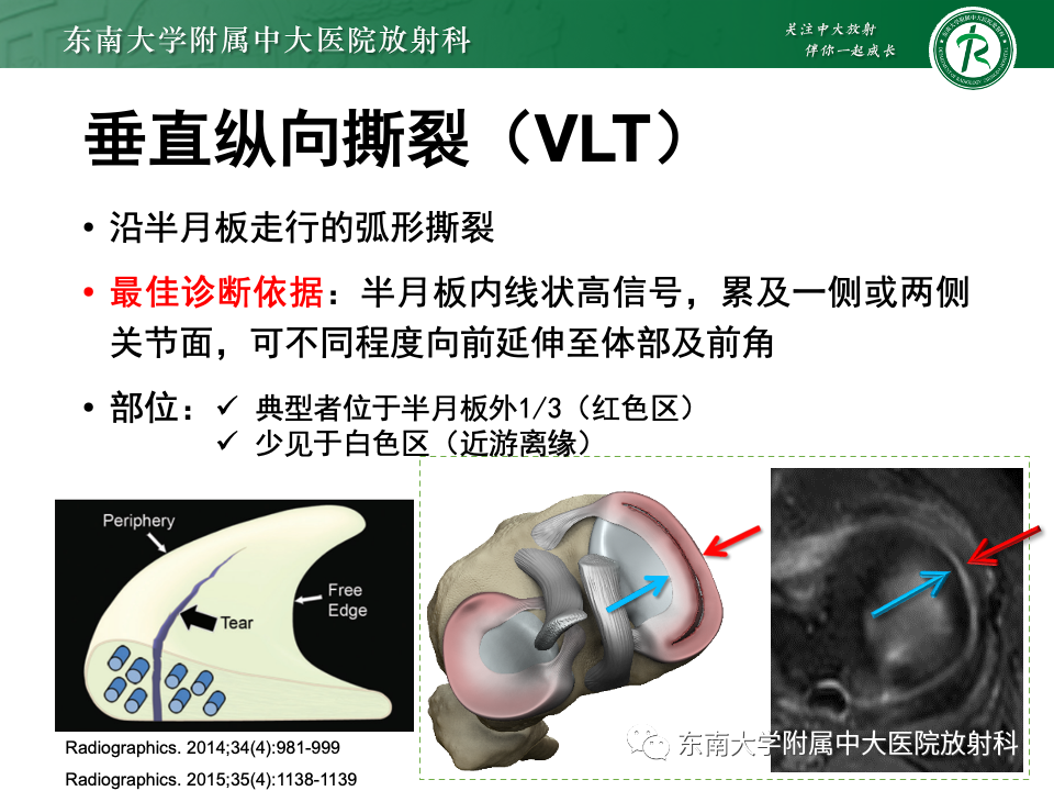 影像PPT - 【PPT】半月板撕裂-22