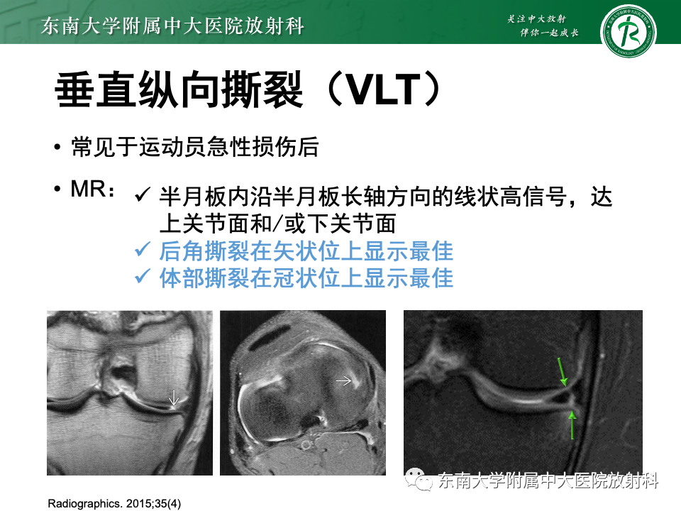 影像PPT - 【PPT】半月板撕裂-23