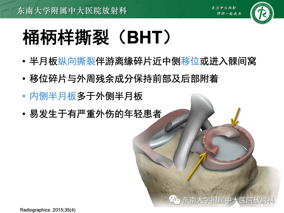 影像PPT - 【PPT】半月板撕裂-24