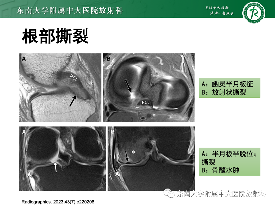 影像PPT - 【PPT】半月板撕裂-27