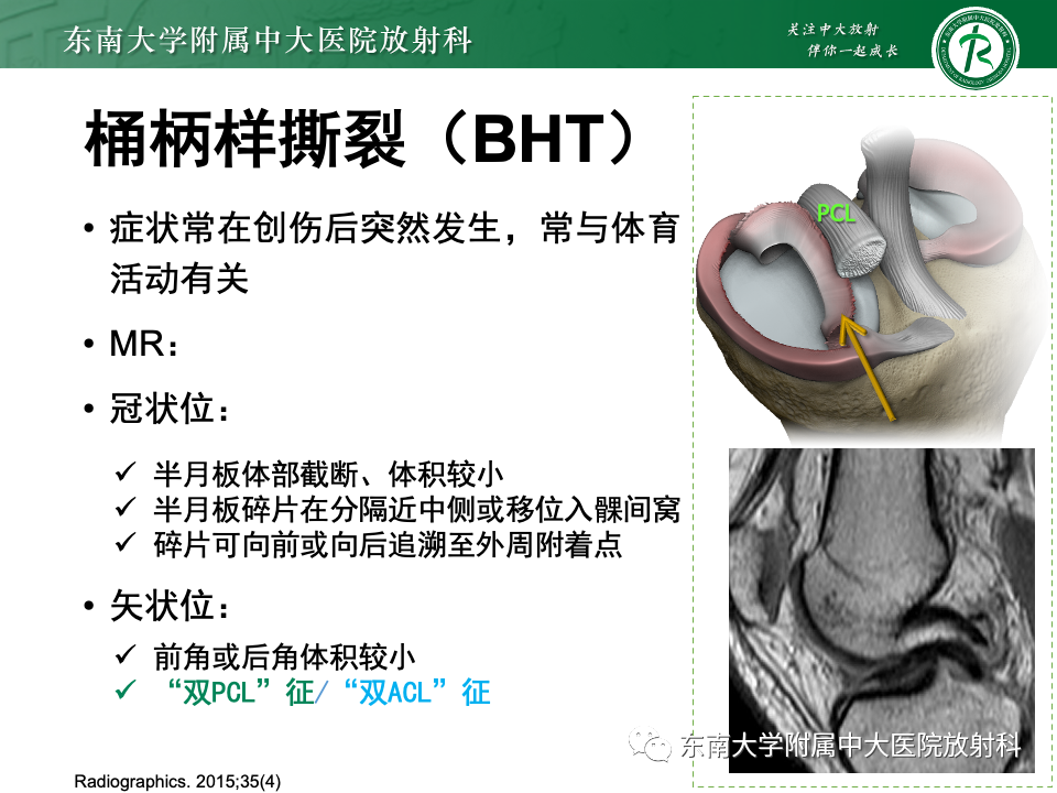 影像PPT - 【PPT】半月板撕裂-25