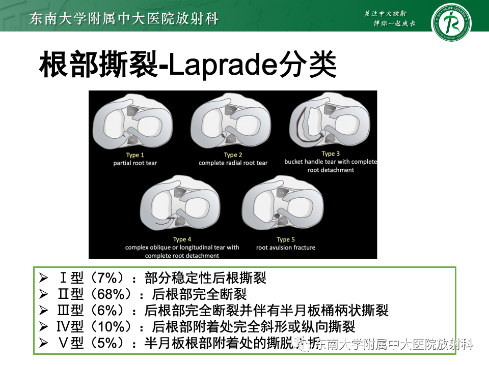 影像PPT - 【PPT】半月板撕裂-28