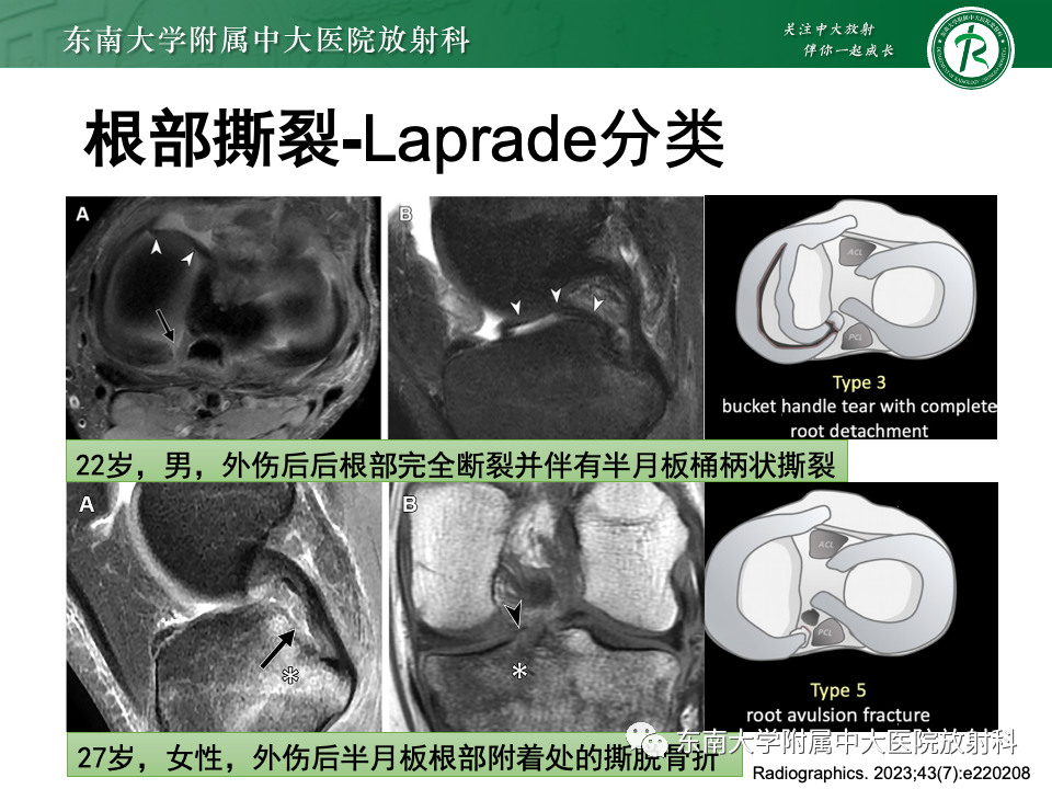 影像PPT - 【PPT】半月板撕裂-29