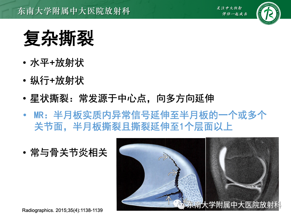 影像PPT - 【PPT】半月板撕裂-32