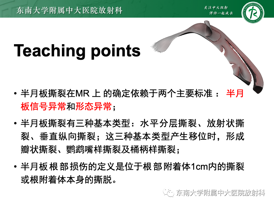 影像PPT - 【PPT】半月板撕裂-33