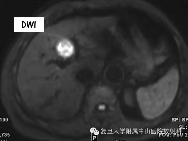 影像PPT - 【PPT】肩关节前向不稳中肩胛盂轨迹影像学评估-2