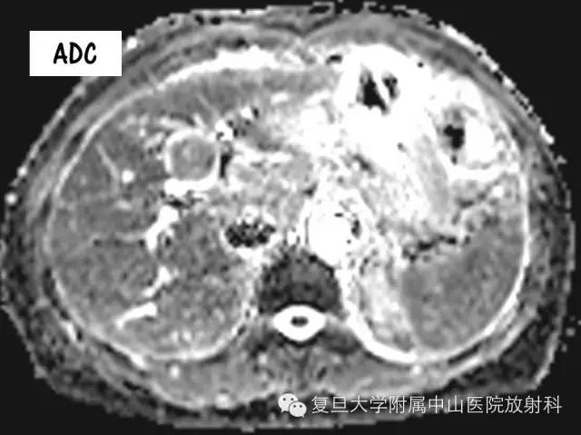 影像PPT - 【PPT】肩关节前向不稳中肩胛盂轨迹影像学评估-3