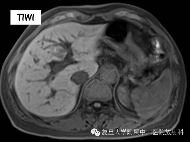 影像PPT - 【PPT】肩关节前向不稳中肩胛盂轨迹影像学评估-4