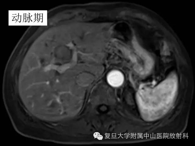影像PPT - 【PPT】肩关节前向不稳中肩胛盂轨迹影像学评估-5