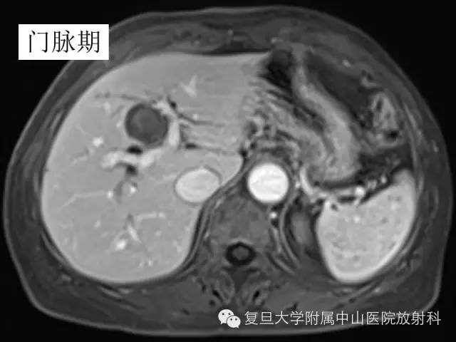 影像PPT - 【PPT】肩关节前向不稳中肩胛盂轨迹影像学评估-6