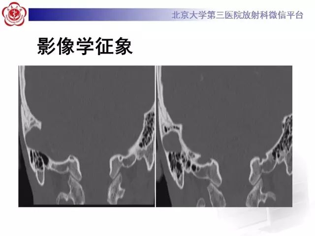 影像PPT - 【PPT】乙状窦前置-4