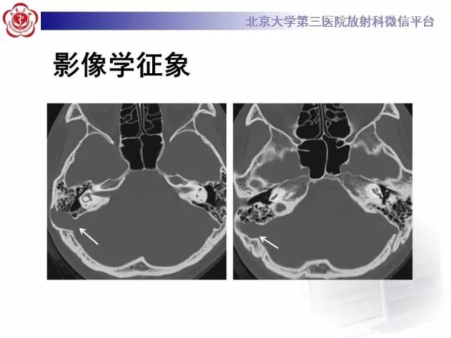 影像PPT - 【PPT】乙状窦前置-3