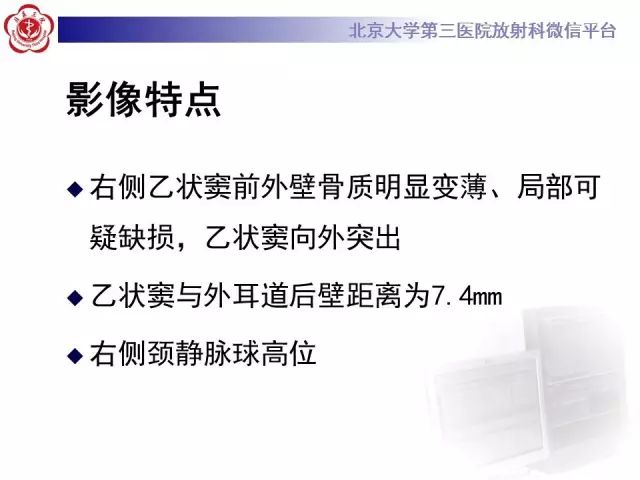 影像PPT - 【PPT】乙状窦前置-5