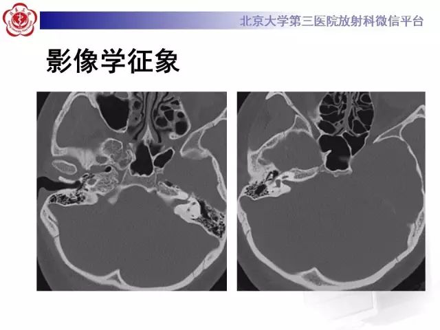 影像PPT - 【PPT】乙状窦前置-8