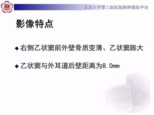 影像PPT - 【PPT】乙状窦前置-9