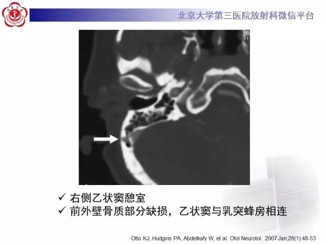 影像PPT - 【PPT】乙状窦前置-18