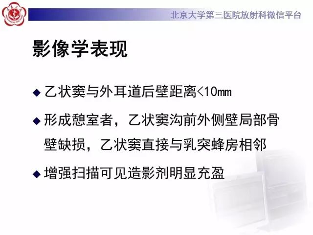 影像PPT - 【PPT】乙状窦前置-17