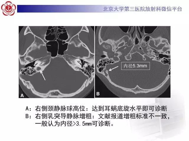 影像PPT - 【PPT】乙状窦前置-20
