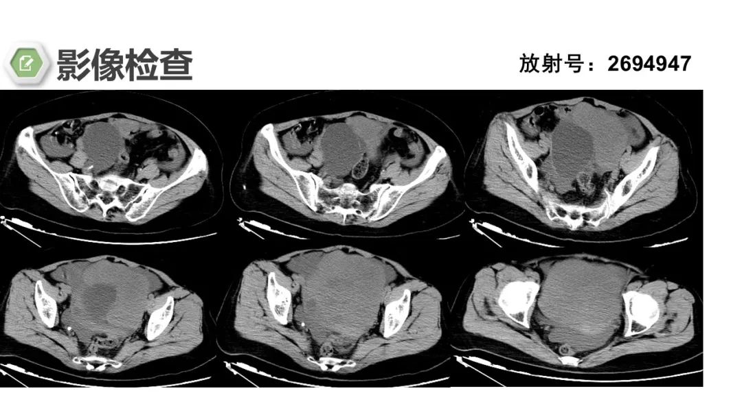 影像PPT - 【病例】卵巢碰撞瘤1例CT影像-3