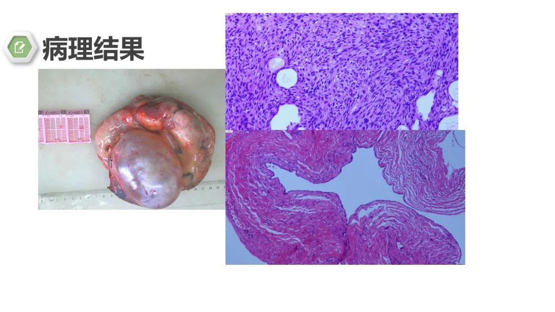 影像PPT - 【病例】卵巢碰撞瘤1例CT影像-9