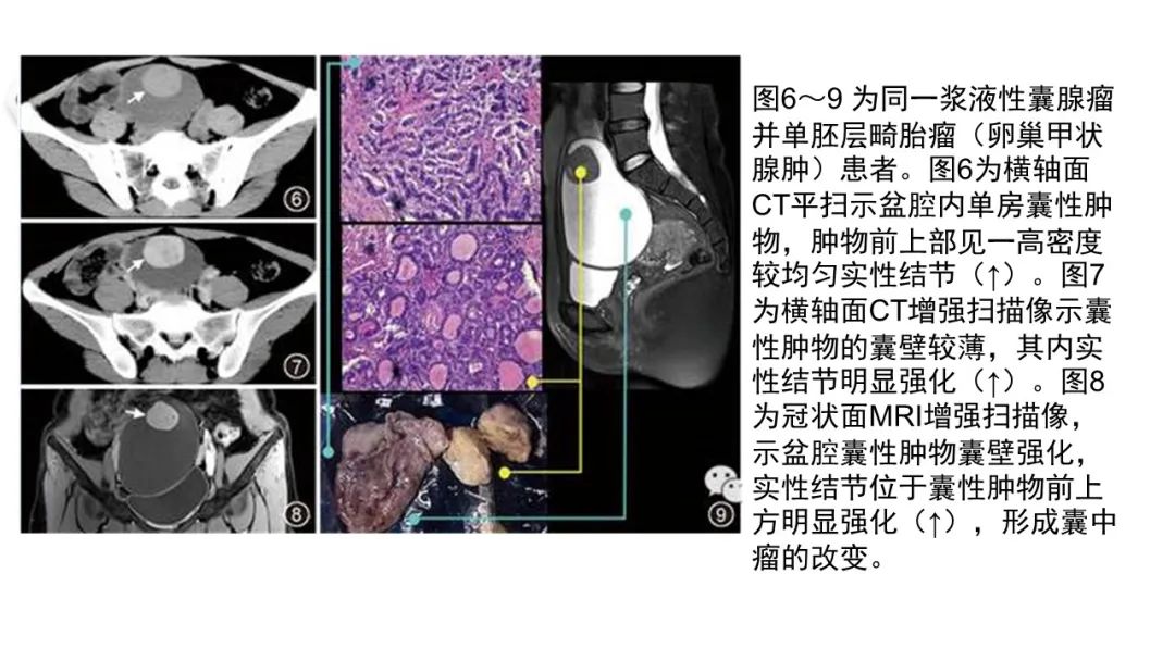 影像PPT - 【病例】卵巢碰撞瘤1例CT影像-14