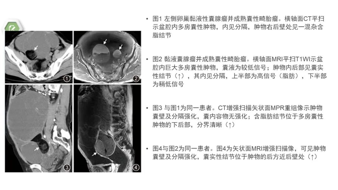 影像PPT - 【病例】卵巢碰撞瘤1例CT影像-13