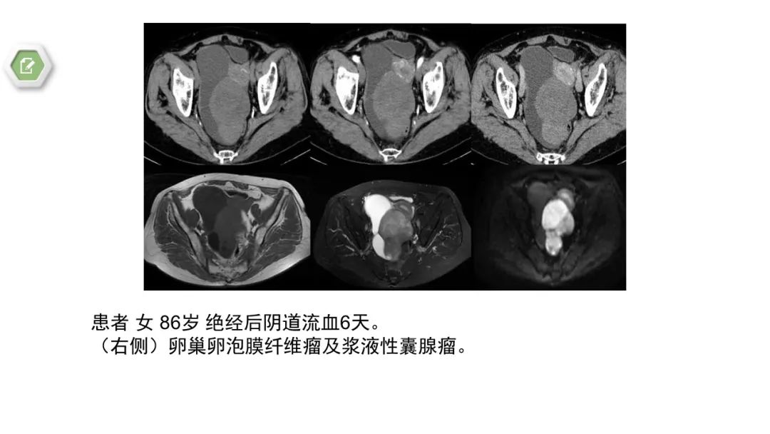 影像PPT - 【病例】卵巢碰撞瘤1例CT影像-16