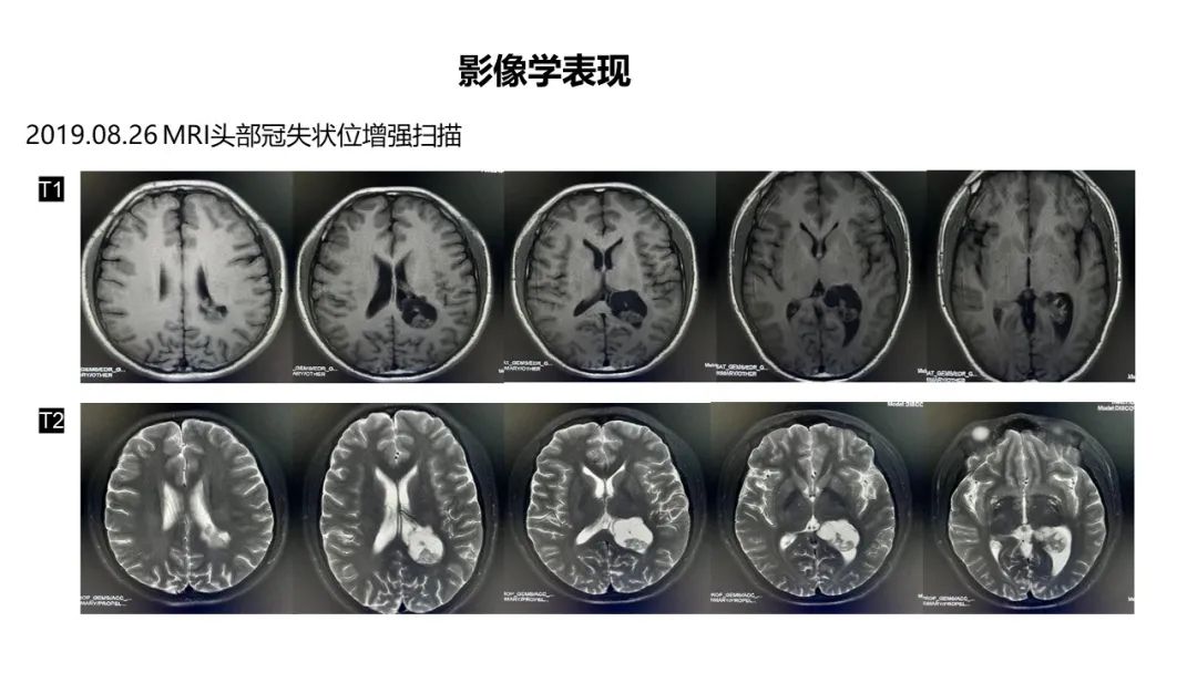 影像PPT - 【病例】侧脑室囊性脑膜瘤1例MR影像-2
