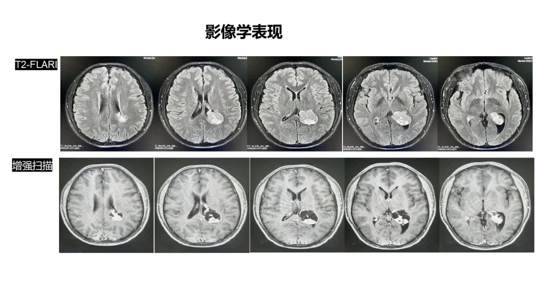 影像PPT - 【病例】侧脑室囊性脑膜瘤1例MR影像-3