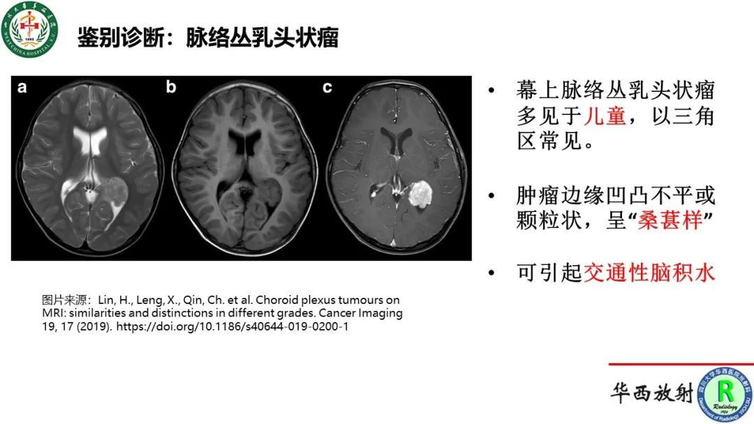 影像PPT - 【病例】侧脑室囊性脑膜瘤1例MR影像-13